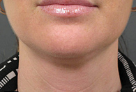 Before Ultherapy skin tightening - San Diego Dermatology and Laser Surgery